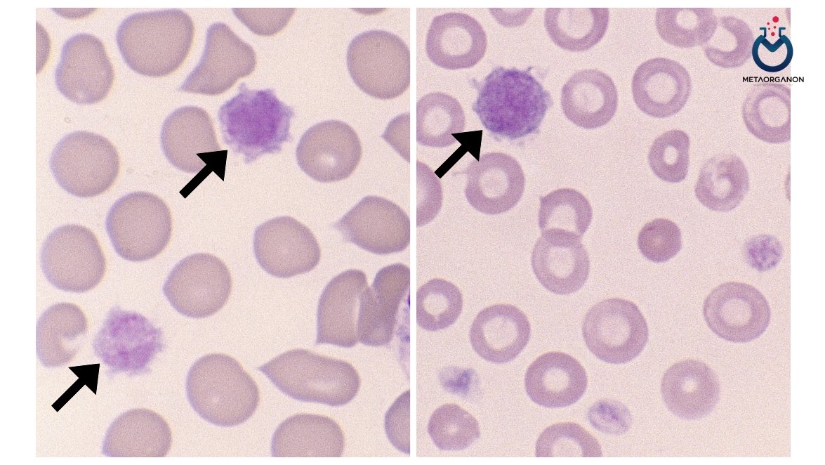 اندکس نسبت سلول های بزرگتر پلاکت (P-LCR) | Platelet larger cell ratio (P-LCR)
