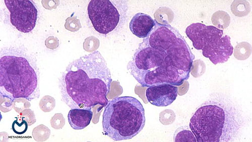 Adult-T-cell-leukemia