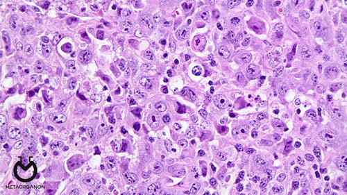 Anaplastic-large-cell-lymphoma