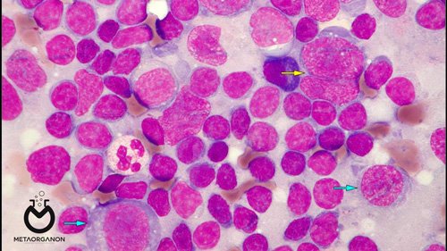 Angioimmunoblastic-T-cell-lymphoma