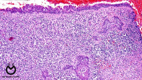 Extranodal-NK-T-cell-lymphoma,-nasal-type