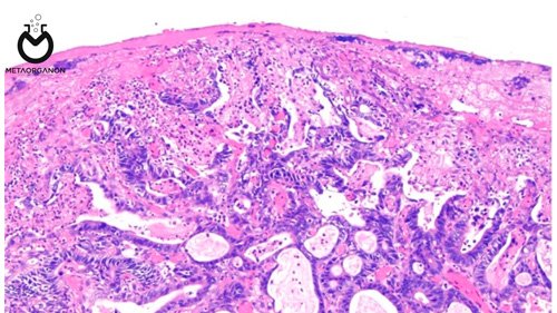 Gastric-or-gastroesophageal-junction-adenocarcinoma,-or-esophageal-squamous-cell-carcinoma)