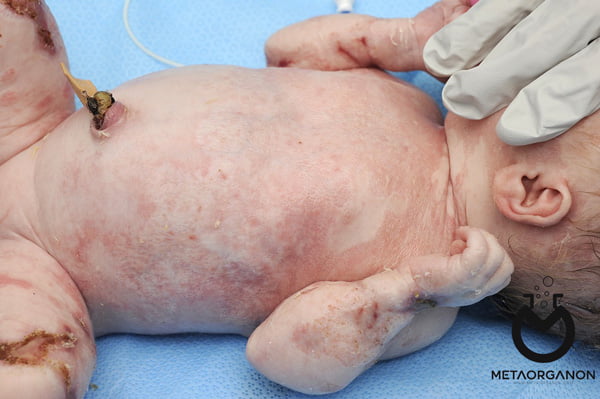 HSV در نوزادان تازه متولد شده