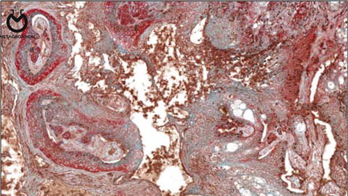 Head-and-neck-squamous-cell-carcinoma