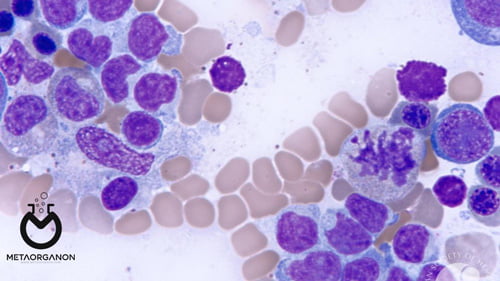 Hepatosplenic-T-cell-lymphoma