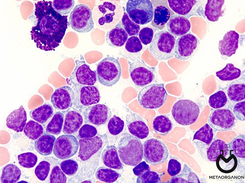 Lymphoplasmacytic lymphoma/Waldenstrom macroglobulinemia