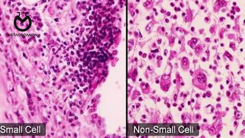 Non-small-cell-lung-cancer