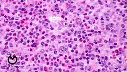 Peripheral-T-cell-lymphoma,-unspecified