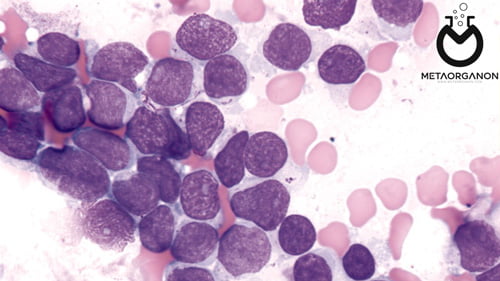 Precursor-T-cell-neoplasm-(T-lymphoblastic-leukemia)