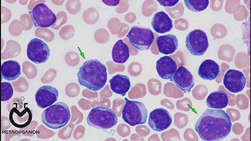 T-cell-prolymphocytic-leukemia