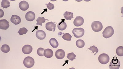 acanthocytes