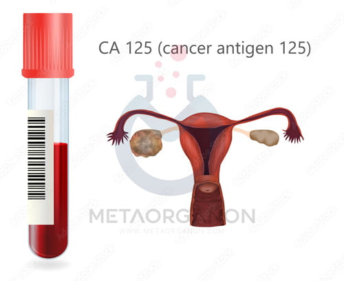ovarian-cancer