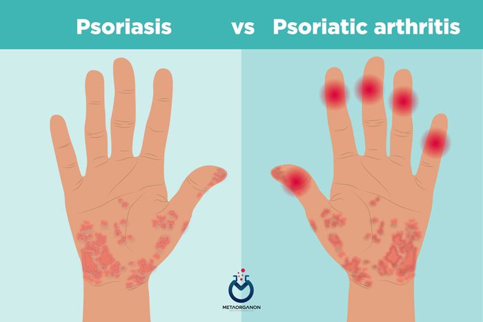 آرتریت-پسوریاتیک-(Psoriatic-Arthritis)