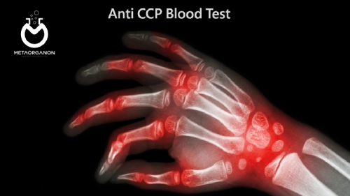آزمایش Anti CCP | آنتی بادی پپتیدی سیترولینه حلقوی | آنتی Cyclic Citrullinated Peptide Antibody | CCP