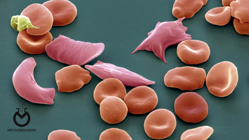 آزمایش سلول داسی شکل | سیکل سل | Sickle Cell | هموگلوبین S
