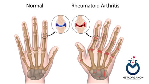 آزمایش های آرتریت روماتوئید | Rheumatoid Arthritis | RA