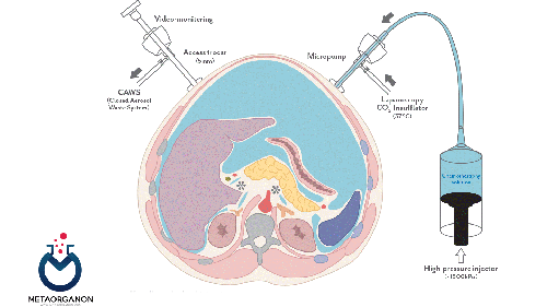 آنالیز مایع صفاقی (مایع آسیت) | Peritoneal Fluid Analysis