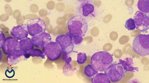 الگوریتم تشخیصی لوسمی پرومیلوسیتیک حاد (APL) | Acute Promyelocytic Leukemia