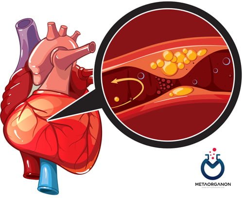 بیماری قلبی عروقی (CVD)