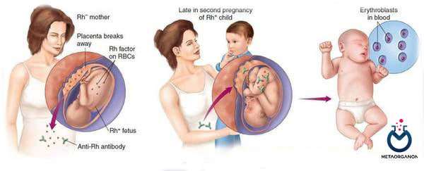 بیماری همولیتیک نوزاد (HDN)