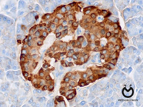 تومور تولید کننده کروموگرانین A