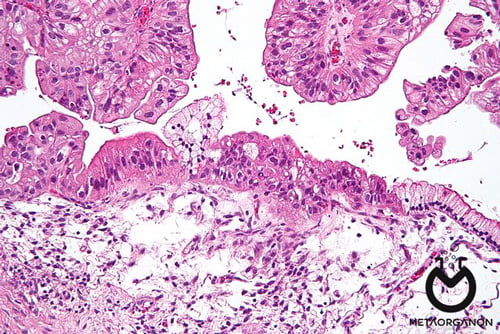 تومورهای اپیتلیال از نوع موسینوس