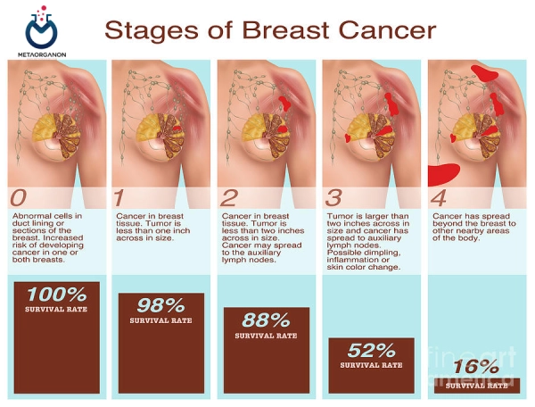 سطوح مختلف سرطان سینه