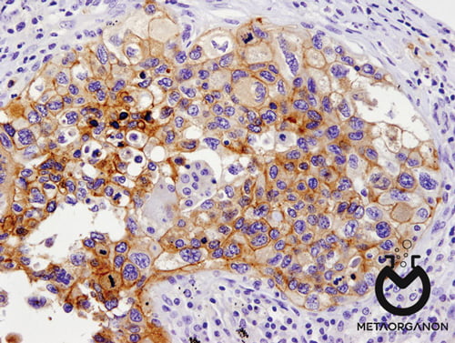 سلول های توموری بیان کننده PD-L1
