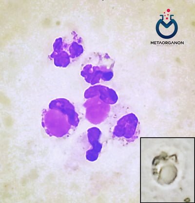 سلول های لوپوس اریتماتوز (LE) در مایع سینوویال