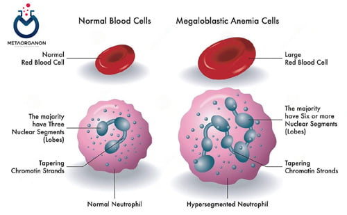 سلول-های-موجود-در-لام-خون-محیطی-آنمی-مگالوبلاستیک