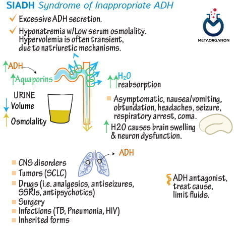 سندرم هورمون ضد دیورتیک نامناسب (SIADH)