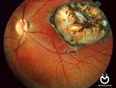 عفونت چشمی توکسوپلاسما