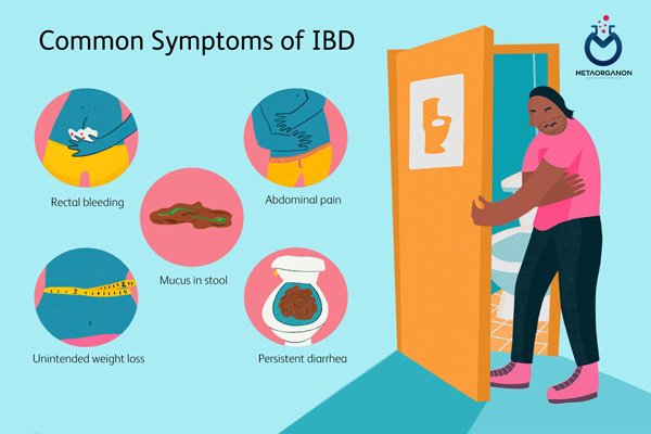 علائم و نشانه های IBD
