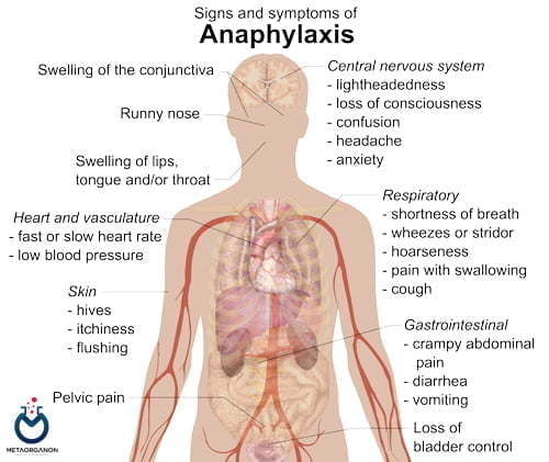 علائم و نشانه های آنافیلاکسی