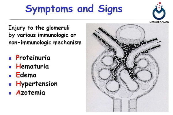 علائم و نشانه های گلومرولونفریت