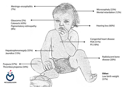 علایم سندرم سرخجه مادرزادی (CRS)