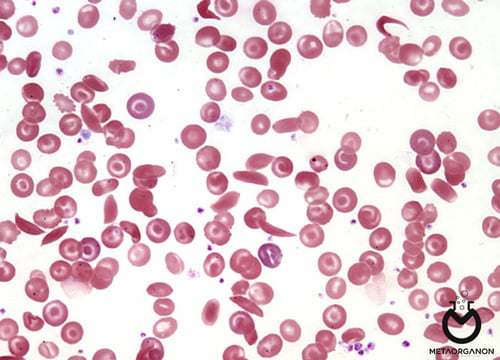 لام خون محیطی حاوی سلول داسی شکل