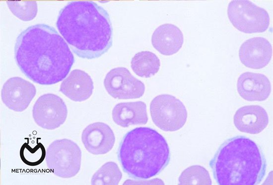 لنفوم سلول گوشته (MCL) یا Mantle cell lymphoma