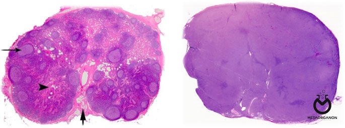 لنفوم منتشر سلول B یا Diffuse large B-cell lymphoma (DLBCL)