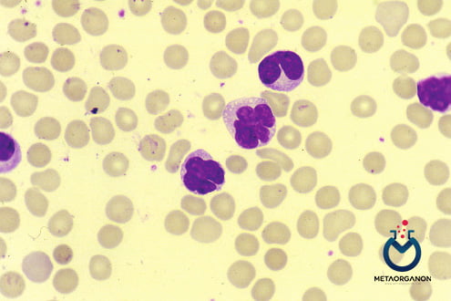 لوسمی یا لنفوم لنفوسیتی سلول T بزرگسالان