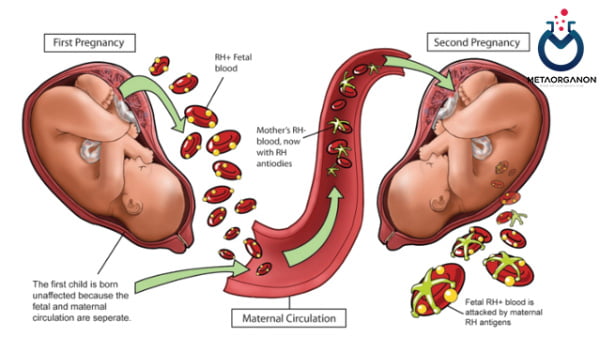 همولیتیک جنین و نوزاد (HDFN)
