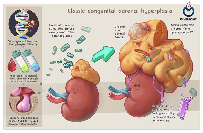 هیپرپلازی مادرزادی آدرنال (CAH)