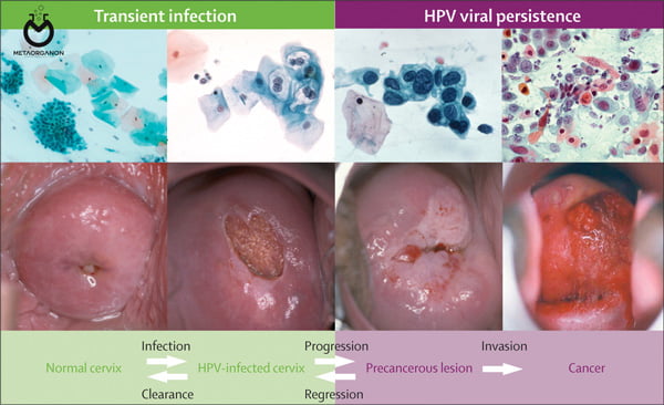 HPV و سرطان دهانه رحم