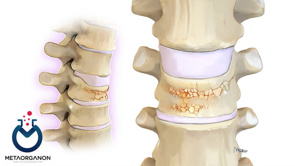 آزمایش های پوکی استخوان | Osteoporosis Tests