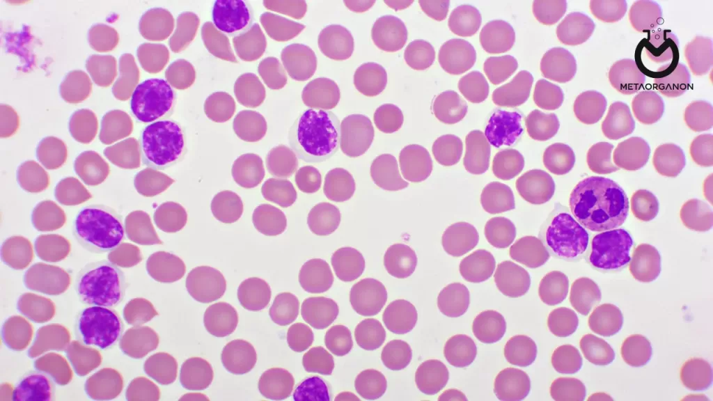 لوسمی لنفوسیتی مزمن (CLL) | Chronic lymphocytic leukemia